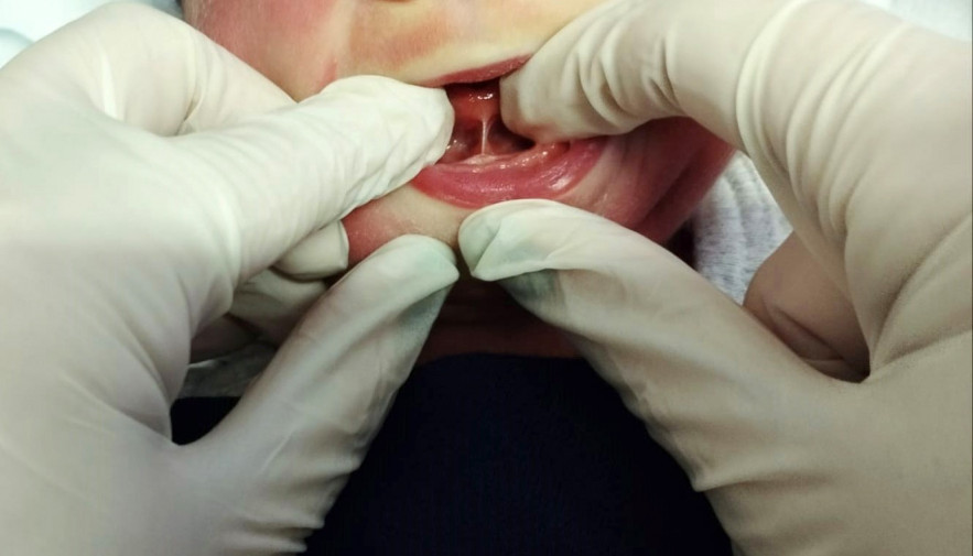 SES-TO enfatiza a importância do Teste da Linguinha